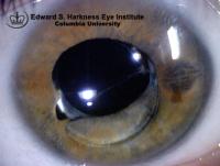 Dislocation of a posterior chamber intraocular lens resulting in the formation of pupillary block glaucoma.